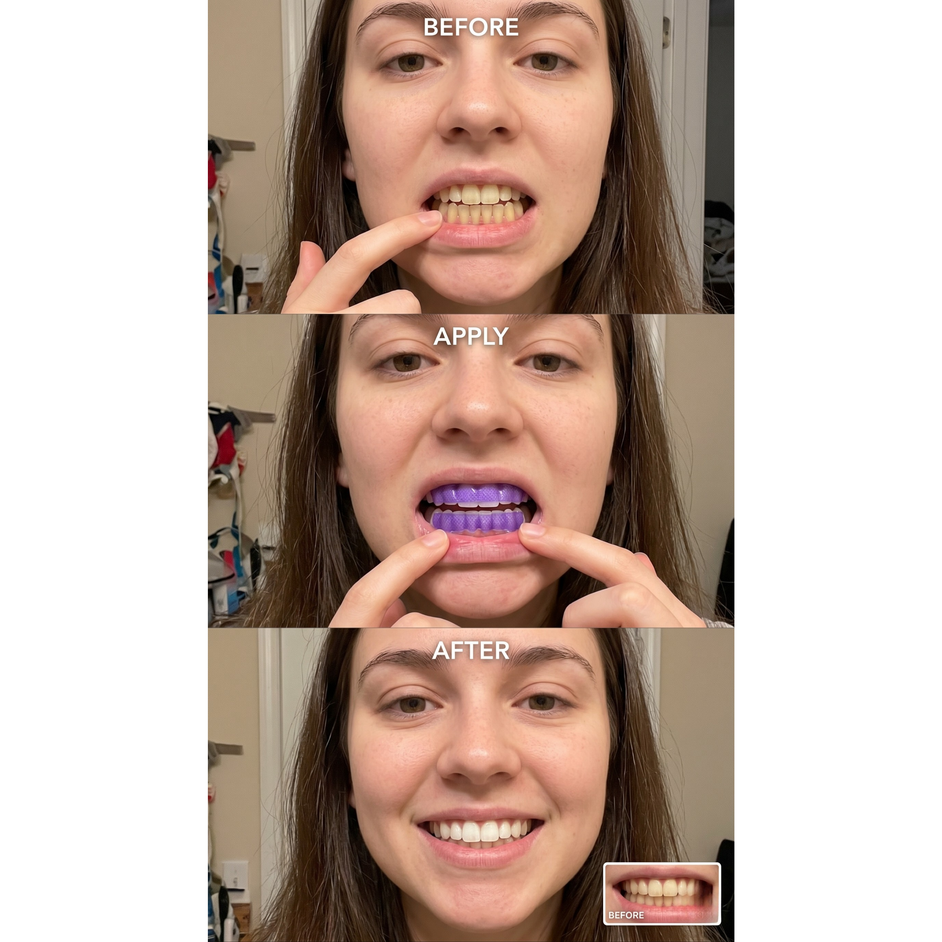Purple Whitening Strips — 14-Day Smile Reset